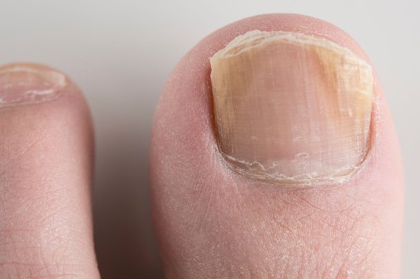 3 Essential Tips to Identify Nail Fungus Infection