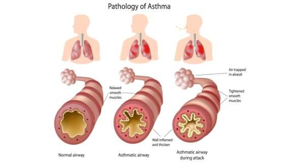 Common Asthma Symptoms and Warning Signs