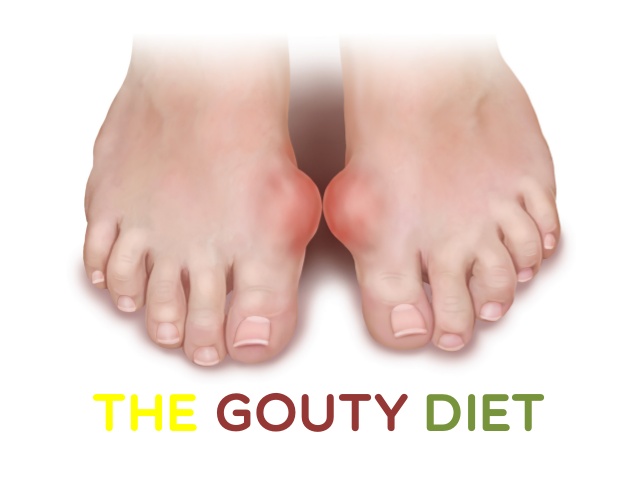 Gouty Arthritis Pain Relief